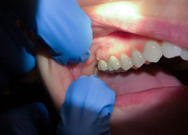 Best Teeth Whitening  in Shreve, OH